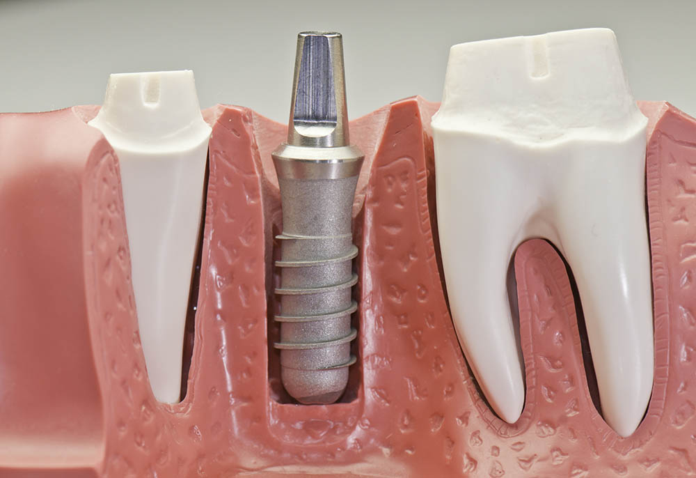 Dental Implant Model